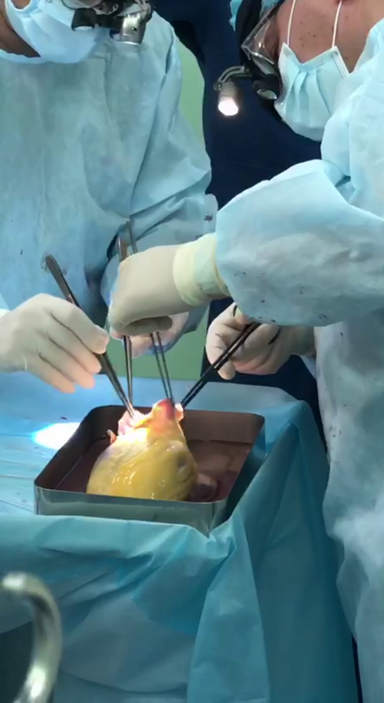 Трансплантація серця у Запоріжжі 